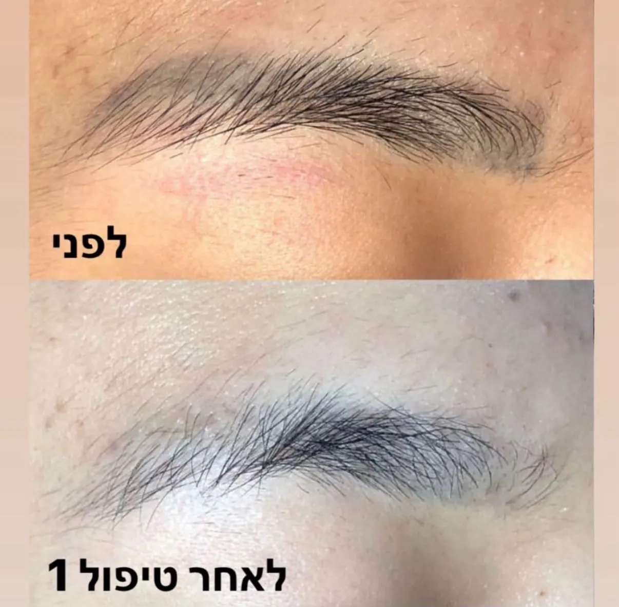 תוצאות הסרת איפור קבוע בגבות